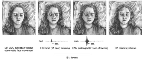 E0：肌电图激活，但没有可观察到的面部运动；E1a：短暂(<1秒)皱眉；E1b：长时间(>1秒)皱眉；E2：抬起眉毛