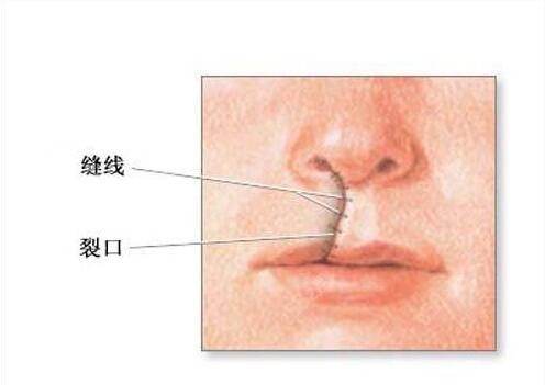 重庆唇裂二期修复好的医院有哪些？松山/军科修复好排前三
