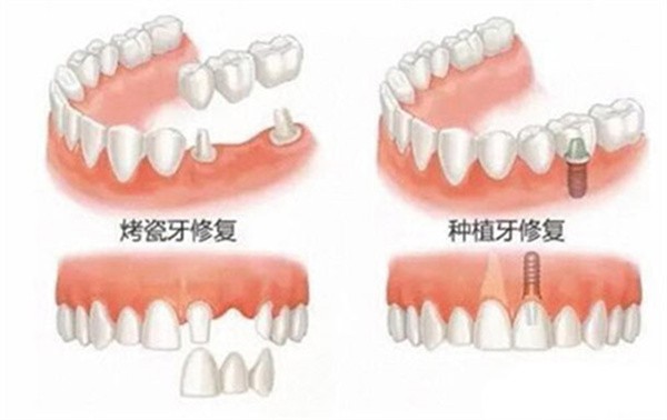 湖南怀化口腔价格表2025，含镶牙种牙补牙拔牙矫正根管治疗