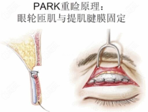 Park法双眼皮的原理