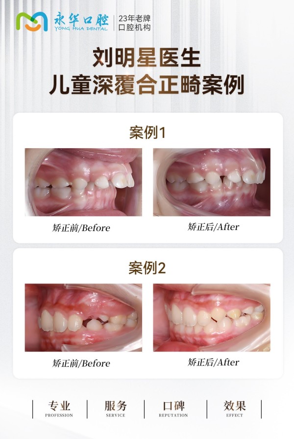 上海正畸医生刘明星谈儿童深覆合是否进行早期干预