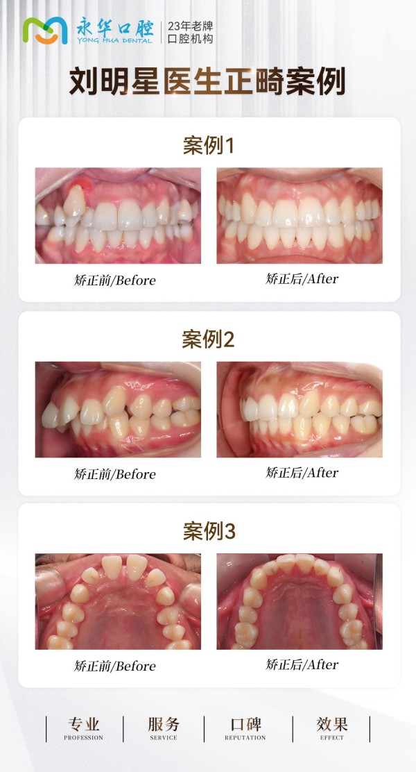 上海正畸医生刘明星谈儿童深覆合是否进行早期干预