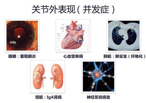 强直性脊柱炎6个地方疼 四项关键措施解析