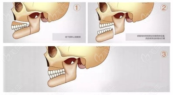 南京正颌医生万林忠简介优势