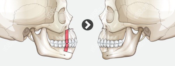 正颌手术改善凸嘴