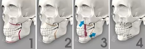 正颌手术手术过程示意图