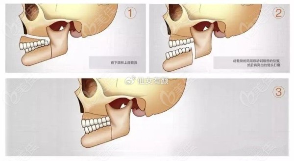 南京正颌医生万林忠简介优势