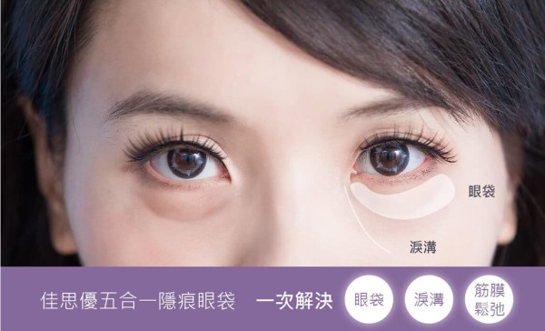 消除眼袋-五合一眼袋手术