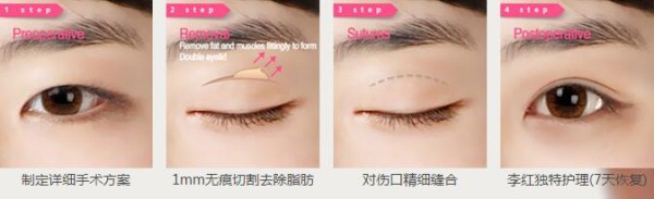 丹东李红明星整形医生做双眼皮多少钱
