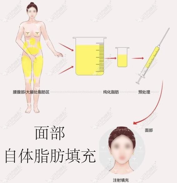 我找王明利做了全面部脂肪填充,亲身经历收费不高脸不变大