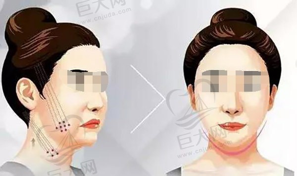 田永成tbm面部提升怎么样