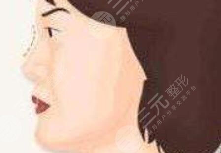 刘凯做鼻子案例