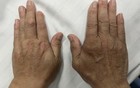 多关节肿痛20载，病因竟是……