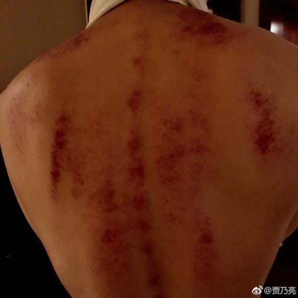贾乃亮录节目病倒 为不耽误第二天工作刮痧去火