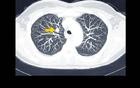 肺结节就是第一癌症？医生提醒：远离8大因素，肺才安全