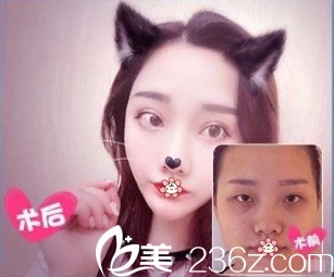 贵阳美贝尔侯舍予双眼皮案例