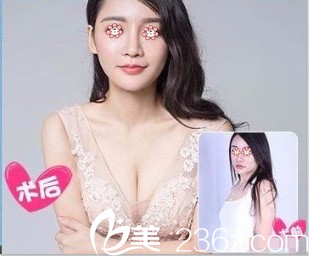 贵阳美贝尔侯舍予自体脂肪丰胸案例