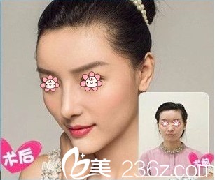 贵阳美贝尔侯舍予隆鼻前后效果对比