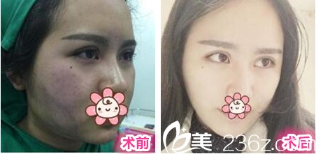 贵阳美贝尔侯舍予面部吸脂案例