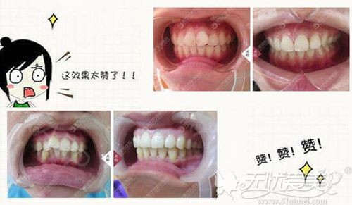 东莞美立方牙齿矫正案例