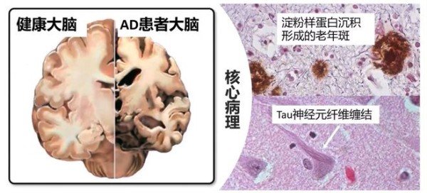 IF=87！首个老年痴呆「基因疗法」临床试验结果发布！点亮新希望