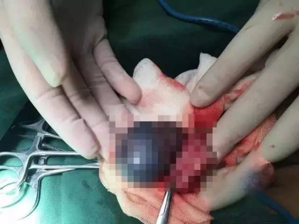 11岁男孩睾丸扭转360°，紫得像葡萄