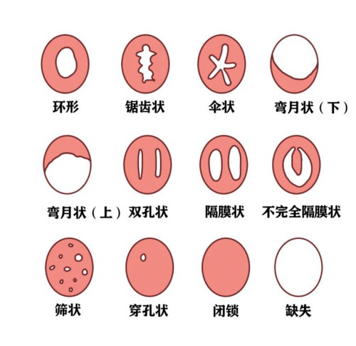 形态各异的处女膜