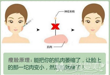 武汉洪山光泽皇后注射瘦脸