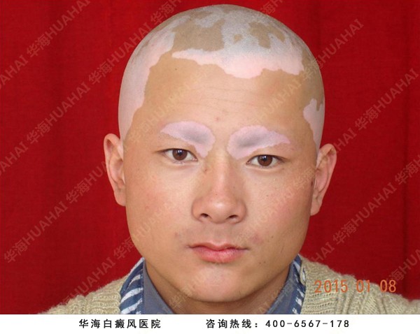 白癜风患者