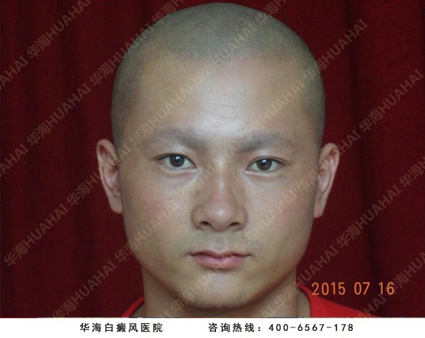 白癜风医院治疗技术