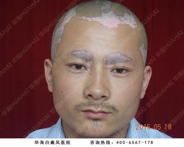 头面部白癜风