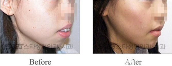 韩国明星star整形外科突嘴矫正案例