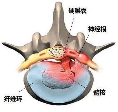图1 腰椎间盘突出解剖示意图