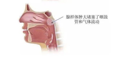 孩子睡觉时张嘴呼吸 打呼噜 小心越长越丑还影响智力