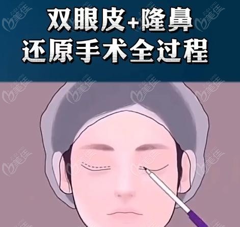 张大艳双眼皮无失败实例