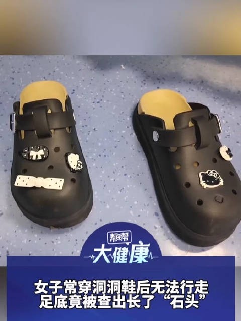 女子常穿洞洞鞋致足底钙化行走困难 医生：鞋底不是越柔软越好 选鞋牢记这三条