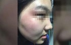 17岁女生被男同学打致颅脑损伤，校方回应
