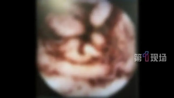 明星同款“彩椒碗”爆火，女子跟风吃出“肠道吸血鬼”，医生紧急提醒→