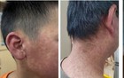刚刚通报！东莞新增11例基孔肯雅热！