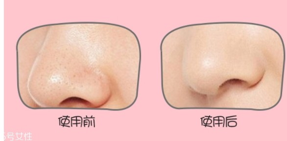 yoii黑头仪怎么用？yoii黑头仪怎么充电