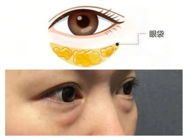 眼袋是怎样产生的