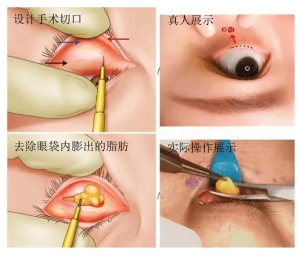眼袋如何消除
