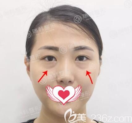 海南瑞韩医学美容医院林晓燕术前照片1