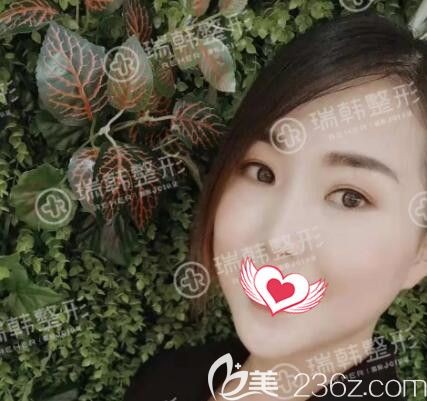 海南瑞韩医学美容医院林晓燕术后照片1