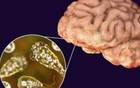 接连两名儿童感染“食脑虫”去世！警惕：病死率极高