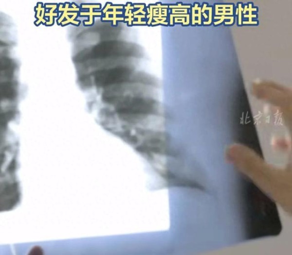 多位明星曾患气胸