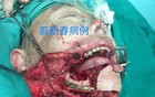 珍爱健康，远离槟榔！