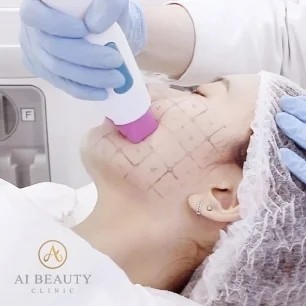 明星们都在做的“热玛吉”到底是什么？效果竟然这么好