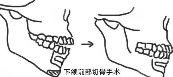 正颌