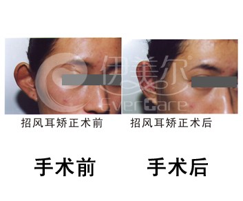 男生招风耳说明什么 男生招风耳好吗